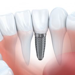 Holland MI, Signs You Need Dental Implants