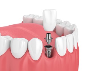 diagram of dental implant