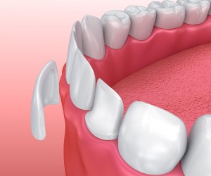 diagram of porcelain veneers